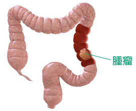大腸的3D圖，大腸中段轉成了紅色強調了腫瘤的位置。