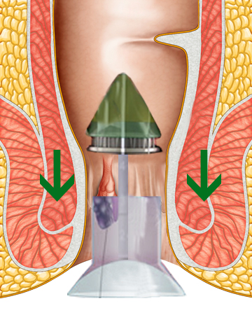 在透視肛門圖中，有一組痔瘡槍放進肛門中，而且有兩個向下的綠色箭嘴。