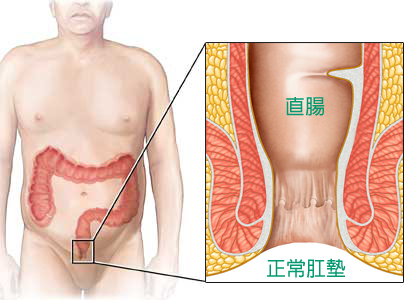 一個人體模型，透視了大腸的位置，大腸末端有一個黑色正方框，旁邊有一個放大了大腸末端的圖，說明直腸和正常肛墊。