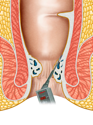 在透視肛門圖中，有一個痔瘡溶解術的裝置放進肛門中。