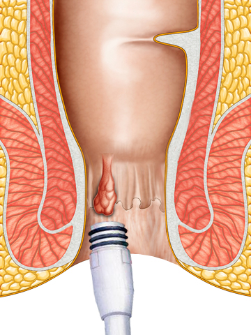 在透視肛門圖中，有一個橡皮圈結紮術的裝置放進肛門中，並指向痔瘡。
