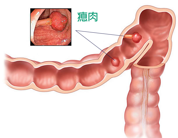 大腸的透視插圖，大腸中有兩顆瘜肉，旁邊有真的瘜肉圖作為描述。
