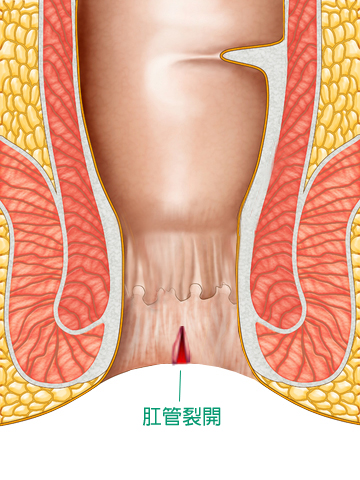 在透視肛門圖中，肛門前端的肛管皮膚裂開，由綠色文字說明肛管裂開。