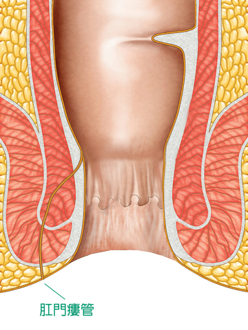 在透視肛門圖中，描述了肛門瘻管的狀況，由綠色文字說明肛門瘻管。