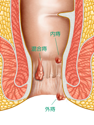 放大了肛門的透視圖，肛門裏有三顆痔瘡，分別綠色文字說明內痔，混合痔和外痔的位置。