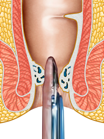 在透視肛門圖中，有一個超聲波無刀除痔術的裝置放進肛門中。